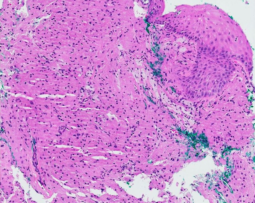 Granular Cell Tumor Of Esophagus A Rare Disease Of The Esophagus